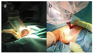 A) Aplicación de radioterapia intraoperatoria mediante electrones y B) mediante fotones de baja energía.