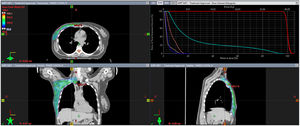Tratamiento locorregional. Se trata del tratamiento con radioterapia adyuvante en una paciente que tras recibir 6 meses de tratamiento sistémico y presentar una respuesta parcial es intervenida de una mastectomía total simple y una linfadenectomía, seguida de radioterapia adyuvante sobre la pared costal y las cadenas ganglionares axilar y supraclavicular homolateral (niveles axilares I-IV), con un esquema de hipofraccionamiento moderado (40,05 Gy en 15 fracciones). Corte de la planificación en axial, coronal y sagital. Adicionalmente el histograma dosis/volumen de la dosimetría.