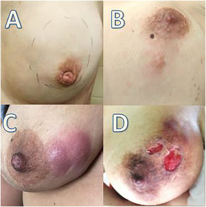 Patrones de Yaghan. A) Tumoración tipo A: asintomática, B) tipo B: tumoración inflamatoria, C) tipo C: tumoración asociada con absceso y D) tipo D: Tumoración con fístulas y úlcera8.