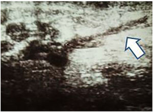 Ecografía mamaria con prolongación digitiforme (fingerlike) desde la lesión (nódulo/área heterogénea) en dirección a la piel (flecha).