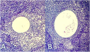 A) MGNQ: vacuola quística rodeada de neutrófilos B) MGNQ con bacilos en su interior (Corynebacterium kroppenstedtii) (40X).