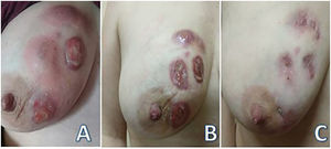 A) Presentación inicial B) A los 2 meses de tratamiento C) A los 6 meses de tratamiento.
