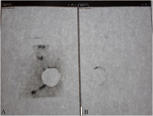 Lymphoscintigraphic planar images for detection (A) and failure to detect SLN (B).