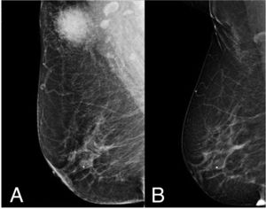 Breast scan before and after surgical management. (A) Patient’s breast scan after being referred to our institution. A dense, round, heterogeneous mass with irregular margins can be observed in the upper outer quadrant of the right breast which corresponded with the palpable lesion presented by the patient. A BIRADS-4 score was once again assigned to the lesion, warranting further investigation. (B) Follow-up study in the same breast 3.5 years after surgical excision of the lesion with minimal scar tissue and contour deformity in the corresponding site. A small calcification within the glandular tissue is present in both studies without suspicion of malignancy, reported as BIRADS 2.