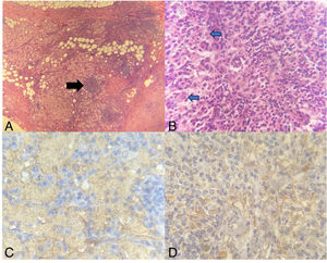 Histopathological analysis of surgical specimen. (A) Breast parenchyma exhibiting a fatty tissue, peripheral hyalinizing fibrotic bands, lymphoplasmacytic infiltration, and nodules of histiocyte proliferation (black arrow); HE-10X. (B) Characteristic lymphoplasmacytic infiltrate accompanied by moderate sclerosis within breast parenchyma, as well as RDD cells (blue arrow with black outline); HE-100X. (C) Positive S100 staining in immunohistochemistry; 400X. (D) Positive CD68 staining; 400X.