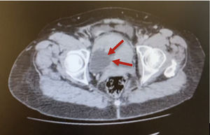 CT revealing a repletion defect in the left lateral bladder wall (marked by red arrows). (For interpretation of the references to color in this figure legend, the reader is referred to the web version of this article.)