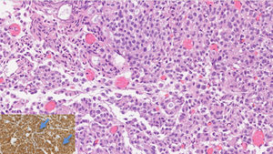 Bladder infiltration by a malignant epithelial tumor, with solid, cribriform and discohesive areas, occasionally forming lines, composed by monomorphic cells (H&E; original magnification 40×). Inlet: The tumor was positive for mammoglobin immunohistochemical marker (highlighted by blue arrows), supporting breast origin.
