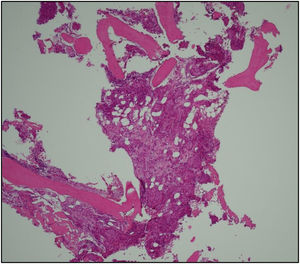 H&E bone marrow trephine slide (40×) showing nests of epithelioid cells infiltrating the intertrabecular spaces.