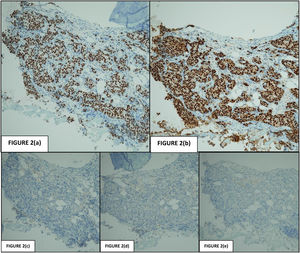 (a) Gata-3 positive cells (100×). (b) Estrogen receptor positive cells (100×). (c) p40 negative cells (100×). (d) p63 negative cells (100×). (e) TTF-1 negative cells (100×).
