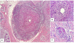 Obsérvese granuloma no caseificante en un lobulillo mamario (H&E). A) Granuloma epitelioide con un espacio central ópticamente vacío (10X). B) Magnificación del centro del granuloma que permite observar los polimorfonucleares alrededor del espacio vacío (40X). C) En otro sector, granuloma con 3 células gigantes multinucleadas tipo Langhans (40X).