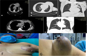 A), B) y C) Tomografía de ingreso de paciente, la que fue informada como lesión neoformativa en la mama izquierda con signos de extensión a la pared torácica y pulmón adyacente. D) y E) Tomografía una vez finalizado el tratamiento, la que es informada como: resolución completa del cuadro infeccioso mamario y pulmonar. F y G) Presentación clínica de tumor, duro, leñoso de la mama izquierda que comprometía prácticamente toda la glándula mamaria.