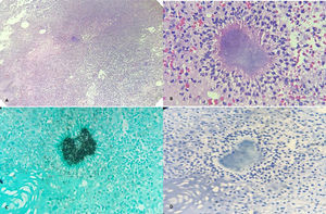 A) Preparado histológico del tejido mamario con formación de abscesos y presencia de colonia bacteriana grampositiva con aspecto filamentoso con características morfológicas de Actinomyces spp, B) coloración de H&E 40X muestra abundantes polimorfonucleares, neutrófilos. A nivel central contenido de absceso con presencia de colonia bacteriana filamentosa característica con corona radiada periférica (gránulo de azufre) de Actinomyces spp, C) coloración de Gomori Grocott 40X actinomyces en color negro, D) coloración Ziehl-Neelsen 40X negativo para bacilos ácido alcohol resistente.