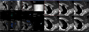 Detección de ganglio centinela (gammagrafía y SPECT/CT).