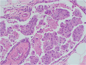 Carcinoma intravascular de configuración papilar.