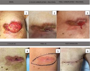 Secuencia cronológica de fotografías de la lesión mamaria a lo largo del tratamiento.