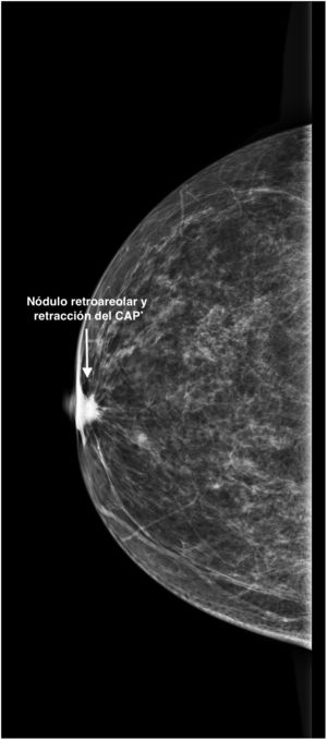 Nódulo retroareolar y retracción del complejo aréola-pezón en la mamografía.