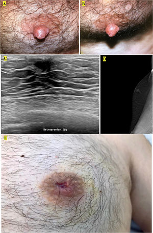 A) y B) Leiomioma en la mama izquierda; C) y D) ecografía/mamografía leiomioma retroareolar izquierdo; E) extirpación del pezón.