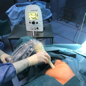 Localización intraoperatoria de la semilla magnética (imagen procedente de un estudio propio).