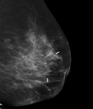 Mamografía con 2 semillas magnéticas (imagen procedente de un estudio propio).