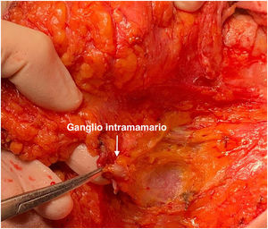 Ganglio intramamario intraoperatorio.