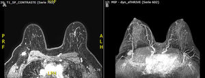 Breast MRI with intravenous contrast. No mass and non-mass enhancements were identified in breast parenchyma bilaterally. The right axilla, level 1, shows enlarged lymph nodules in a cluster of 10 mm×14 mm. (A) Post-contrast T1w image. (B) T2w image.