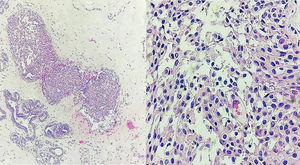 Ductal carcinoma in situ. (A) Intraductal proliferation of atypical ductal cells. Cohesive in a solid growth pattern, columnar changes in slightly dilated and ecstatic ducts are seen. (B) Close-up at 40× magnification. Uniformly spaced cells with moderate nuclear pleomorphism and occasional prominent nucleoli.