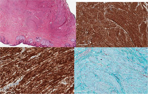 Leiomioma con tinciones hematoxilina-eosina (superior-izquierda), actina (superior-derecha), desmina (inferior-izquierda) y tricrómico de Masson (inferior-derecha).