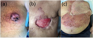 Physical examination of the left breast. A. Basal examination: a 6 cm indurated mass on the nipple with ulceration and scabs over mild erythema. B. Dehiscence suture with peripheral nodules that suggested tumor recurrence. C. Cutaneous progression: nodular lesions throughout the left hemiabdomen.