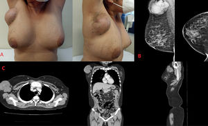 A) Exploración física (frontal y lateral). B) Mamografía: MLO y CC, C. TEM: axial, coronal y sagital.