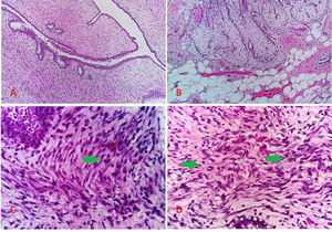 Tumor phyllodes intermedio axilar, hallazgos histopatológicos. A) Proliferación fibroepitelial con patrón foliáceo e hipercelularidad estromal. B) La tumoración infiltra el tejido adiposo circundante. C y D) A mayor aumento las células estromales presentan pleomorfismo celular moderado y presencia de numerosas figuras mitóticas (flechas).