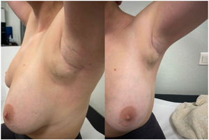 Aspecto de la masa axilar por la que la paciente consulta inicialmente. A) Vista lateral. B) Vista anteroposterior.