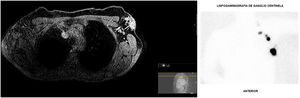 Pruebas de imagen. A) RM de la axila izquierda, evidenciándose el tumor axilar. B) Captación de m99Tc en los ganglios de la axila izquierda para la BSGC.