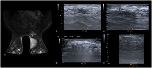 A) Imagen de RM. Secuencia dinámica T1 con saturación grasa y administración de gadolinio IV. Nódulo de morfología y bordes irregulares en el cuadrante inferointerno de la mama izquierda con captación de contraste heterogéneo (curva tipo 3). Está localizado a 17 mm de la piel, 56 mm del complejo aréola-pezón y 96 mm de la pared torácica. Tras la realización de BAG, se obtuvo un resultado de carcinoma ductal infiltrante Luminal A. B-D) Imágenes de la ablación guiada por ecografía. B) Nódulo hipoecoico de morfología irregular y bordes espiculados. Se planifica el abordaje desde los cuadrantes internos. C) Se atraviesa el eje longitudinal del tumor y el bisel de la sonda sobrepasa la lesión. D) Durante el procedimiento se van evidenciando cambios en la estructura tumoral, con desarrollo de una hiperecogenicidad progresiva. E) Imagen ecográfica del control realizado al mes de la intervención, donde se observa la formación de un área de necrosis grasa.