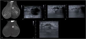 A y B) Mamografía con contraste en proyección mediolateral oblicua. Nódulo irregular de bordes espiculados de 26 mm localizado en cuadrante superoexterno de la mama izquierda, que condiciona retracción cutánea. En las imágenes recombinadas se observa un realce intenso de la lesión. Tras la realización de BAG, se obtuvo un resultado de carcinoma ductal infiltrante Luminal B. C-E) Imágenes de la ablación guiada por ecografía. C) Tras la planificación del abordaje, y debido al tamaño y cercanía del nódulo con el plano cutáneo, se decidió realizar la ablación realizando 2 pases. D) En primer lugar se realizó la ablación de la parte más irregular y profunda E) para posteriormente ablacionar la parte central y superficial, D y E) realizándose durante todo el procedimiento hidrodisección continua del plano subcutáneo y aplicación de hielo local para evitar el calentamiento de la piel (D y E). F) Imagen ecográfica del control realizado al mes de la intervención. Se observan cambios postratamiento con cierta degeneración quística interna y necrosis grasa a su alrededor.