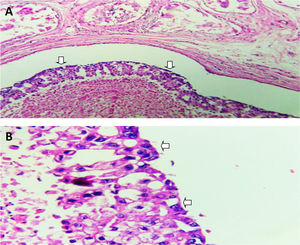 A y B) Tinción de H&E 10X y 40X. Área de carcinoma in situ en la mama izquierda tipo comedo.