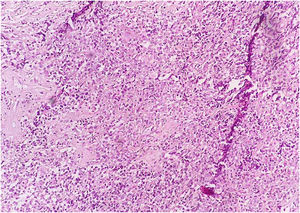 Complete effacement of normal breast tissue architecture by a diffuse infiltrate of large (or occasionally medium size) atypical B lymphoid cells with vesicular chromatin and prominent nucleoli.