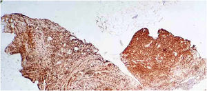 Tumor cells are positive for CD20.