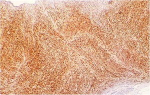 Nuclear staining for Mum 1 in tumor cells.