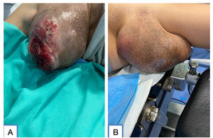 A) Gigantomastia gestacional con ulceración en tejido mamario ectópico en axila derecha. B) Gigantomastia gestacional en tejido mamario ectópico en axila izquierda.