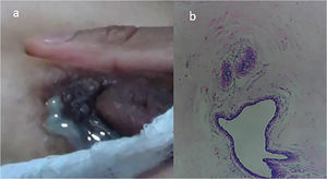 a) Absceso de mama con fistula. b) Tejido mamario con infiltrado inflamatorio, con formación de granuloma.