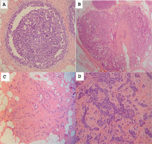(A) Usual ductal hyperplasia showing intraluminal cellular proliferation. The cells are arranged in streams, and they tend to overlap. They delineate irregular-shaped spaces. (B) Radial scar showing a central area of sclerosis and a lobulocentric architecture. (C) Complex sclerosing lesion with irregular acinar proliferation, surrounded by collagenous stroma. (D) Sclerosing adenosis is characterized by the proliferation of epithelial and myoepithelial cells embedded in a collagenous stroma.