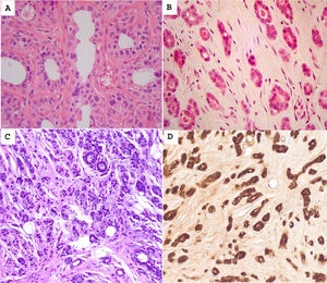 (A) Atypical apocrine adenosis showing acini lined by cells with pink granular cytoplasms. The nuclei are hyperchromatic and moderately pleomorphic. (B) Microglandular adenosis showing rounded acini containing eosinophilic secretions. (C) Atypical microglandular adenosis shows rounded acini with intraluminal secretions. Some acini are irregular and fused. (D) S100 immunostaining shows diffuse positivity. (For interpretation of the references to color in this figure legend, the reader is referred to the web version of this article.)