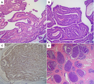 (A) Intraductal papilloma showing branching papillae with fibrovascular cores. (B) A double layer of epithelial and myoepithelial cells lines them. (C) p63 immunostaining shows positive myoepithelial cells. (D) Multiple papillomas occupy distended ductal spaces.