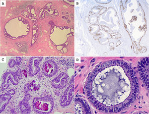 (A) Atypical ductal hyperplasia shows epithelial cell proliferation, with low-grade nuclear atypia, forming micropapillae and cellular bridges. (B) CK14 immunostaining is limited to the myoepithelial layer and a few foci of usual ductal hyperplasia. (C) Flat epithelial atypia showing distended acini with intraluminal calcifications. (D) The acinus is lined by epithelial cells with overlapping, rounded nuclei.