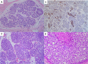 (A) Lobular carcinoma in situ, classical type, showing distended acini completely occupied by poorly cohesive, rounded cells. (B) E-cadherin immunostaining with lack of expression in the lobular carcinoma in situ. (C) Lobular carcinoma in situ, florid type, with markedly distended acini and low-grade cellular atypia. (D) Lobular carcinoma in situ, pleomorphic type. The cells are markedly atypical, showing eccentrically located nuclei. Focal necrosis is shown.