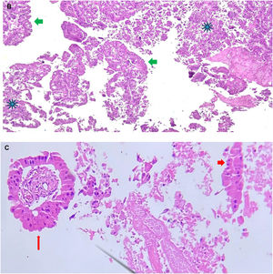 Imagen microscópica. Hematoxilina y eosina. Aumento 4X. B) se aprecian vistas panorámicas de la neoplasia que es escasa porque predomina el componente necrótico (*). También se puede ver un infiltrado inflamatorio denso. Se observa una configuración papilar (➔). C) Las estructuras de los extremos son el componente que resalta en esta neoplasia y es la metaplasia apocrina (➔) no obstante casi el 80% era necrosis.