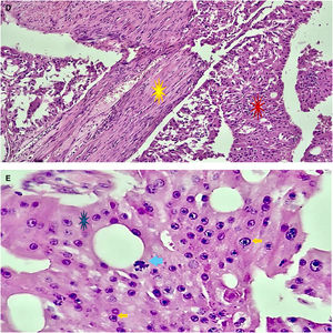 Imagen microscópica. Hematoxilina y eosina. Aumento 10X. D) Se observa la cápsula (*) alrededor de la neoplasia que con una arquitectura papilar tiene predominantemente cambios de metaplasia apocrina (*). E) La acidofilia y las características metaplásicas apocrinas en estructuras papilares asociadas al pleomorfismo son propios de esta neoplasia (*). Se observan las células con citosol granulado que se tiñe con eosina que poseen núcleos grandes y nucléolos prominentes (➔). También es característica la mitosis atípica (➔).