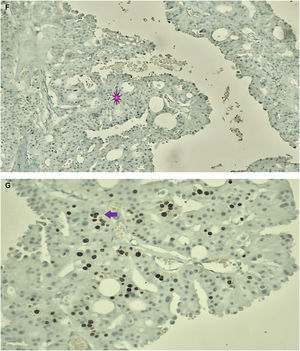 Imagen microscópica. Inmunohistoquímica. F) Se observa tinción negativa para receptores HER2 (*). G) Revela la presencia de Ki67 en 10% (➔).