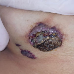 Macroscopic picture shows an ulcerated mass and another reddish-purple lesion with raised growth on the skin. (For interpretation of the references to color in this figure legend, the reader is referred to the web version of this article.)