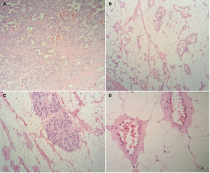 (A) Image shows dermal vascular proliferation with reactive changes underlying skin ulceration. H&E, 100×. (B) Well-differentiated vascular lesion infiltrating hypodermis. H&E, 100×. (C) The lesion infiltrates the interlobular stromal of the breast without invading the intralobular stroma H&E, 100×. (D) High magnification of the vascular lesion shows minimal to no endothelial atypia. H&E, 400×.